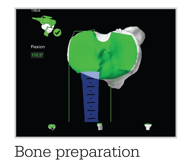 3d Bone Scan or Knee Surgery