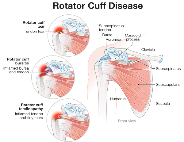 rotator cuff disease
