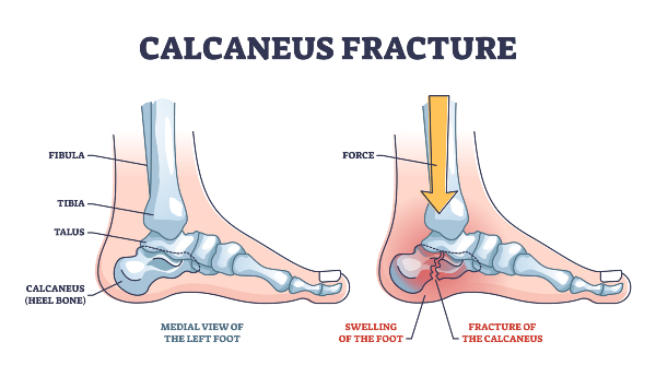 diagram of calcaneus fracture