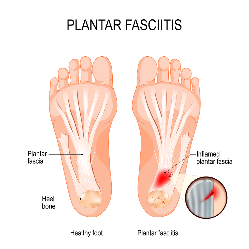 diagram of plantar fasciitis