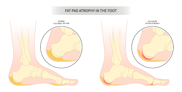 heel pad atrophy in the foot