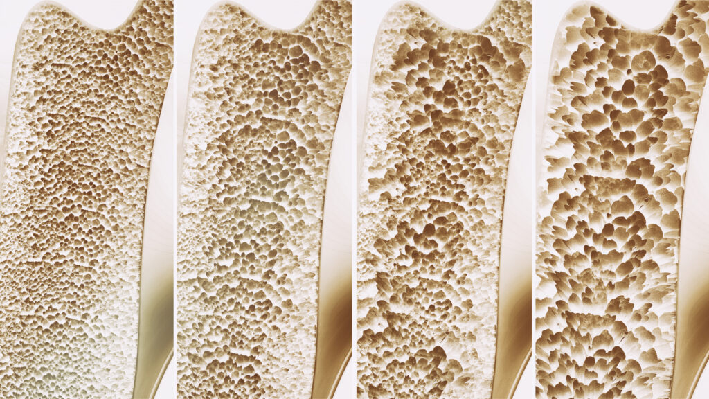 bones affected by osteoporosis