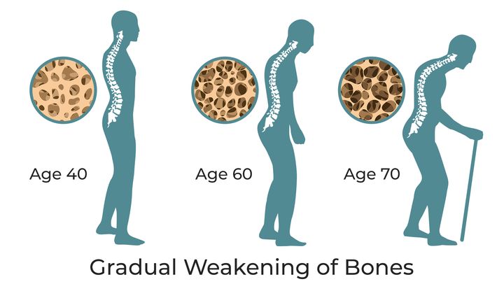 Gradual Weakening of Bones