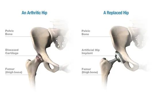 Replaced vs Arthritic Hip